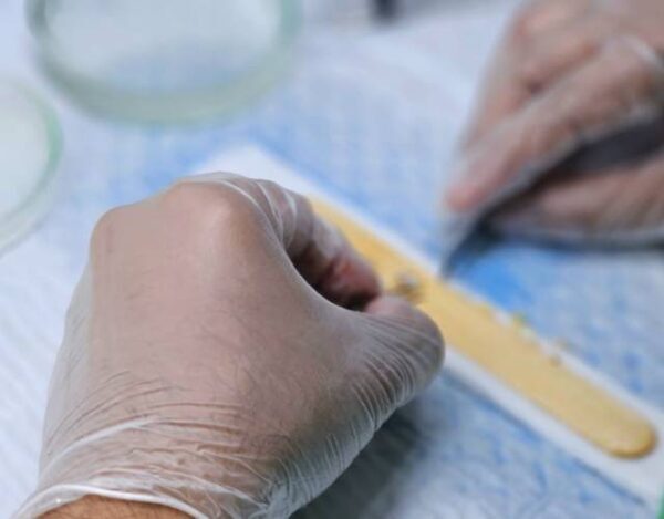 DHI أم سافير FUE؟ أي طريقة زراعة الشعر هي الأنسب لك؟